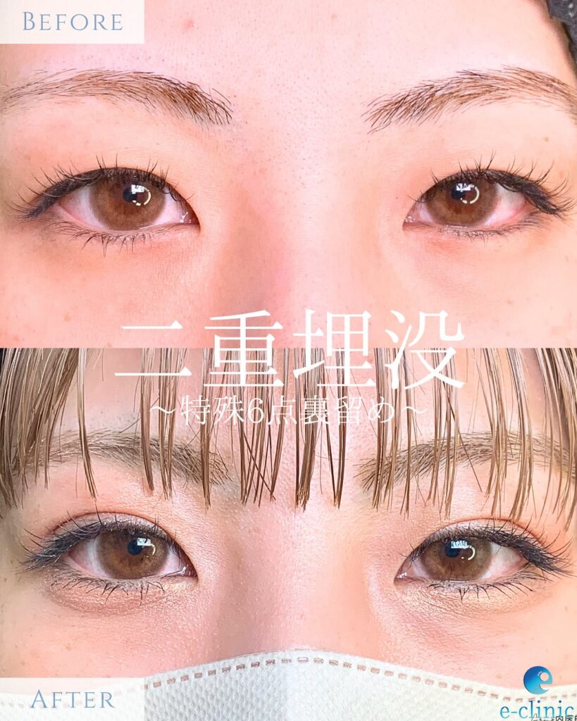 埋没法の症例写真 (18)