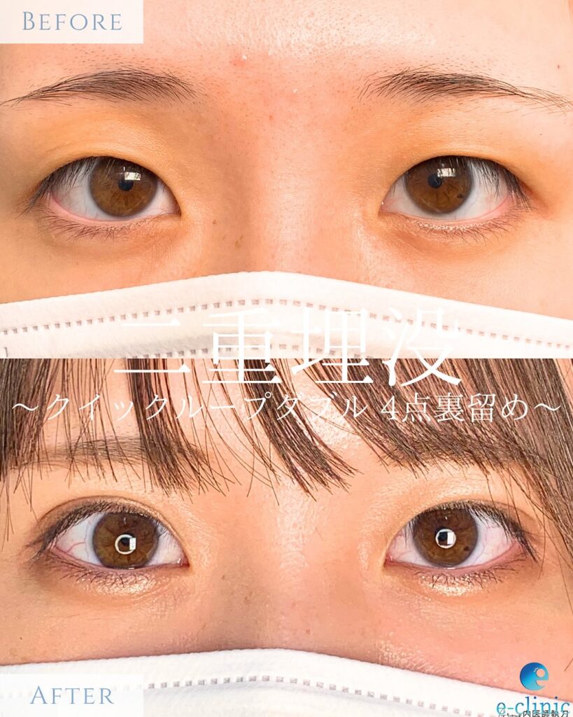 埋没法の症例写真 (17)