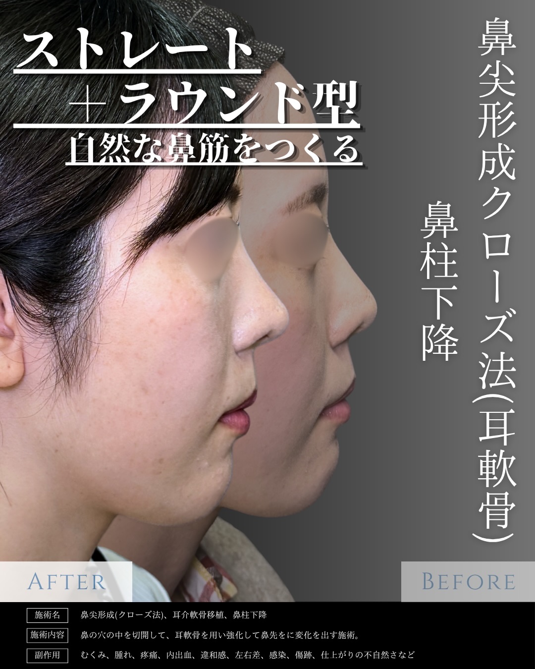 クローズ法の鼻尖形成と耳介軟骨移植と鼻柱下降を行った症例