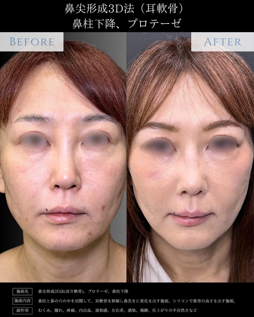 正面から見た40代の鼻尖形成3D法と耳介軟骨移植と鼻柱下降とプロテーゼの症例