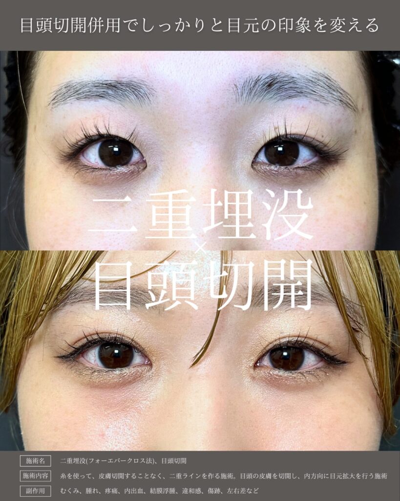 埋没法と目頭切開症例写真 (2)