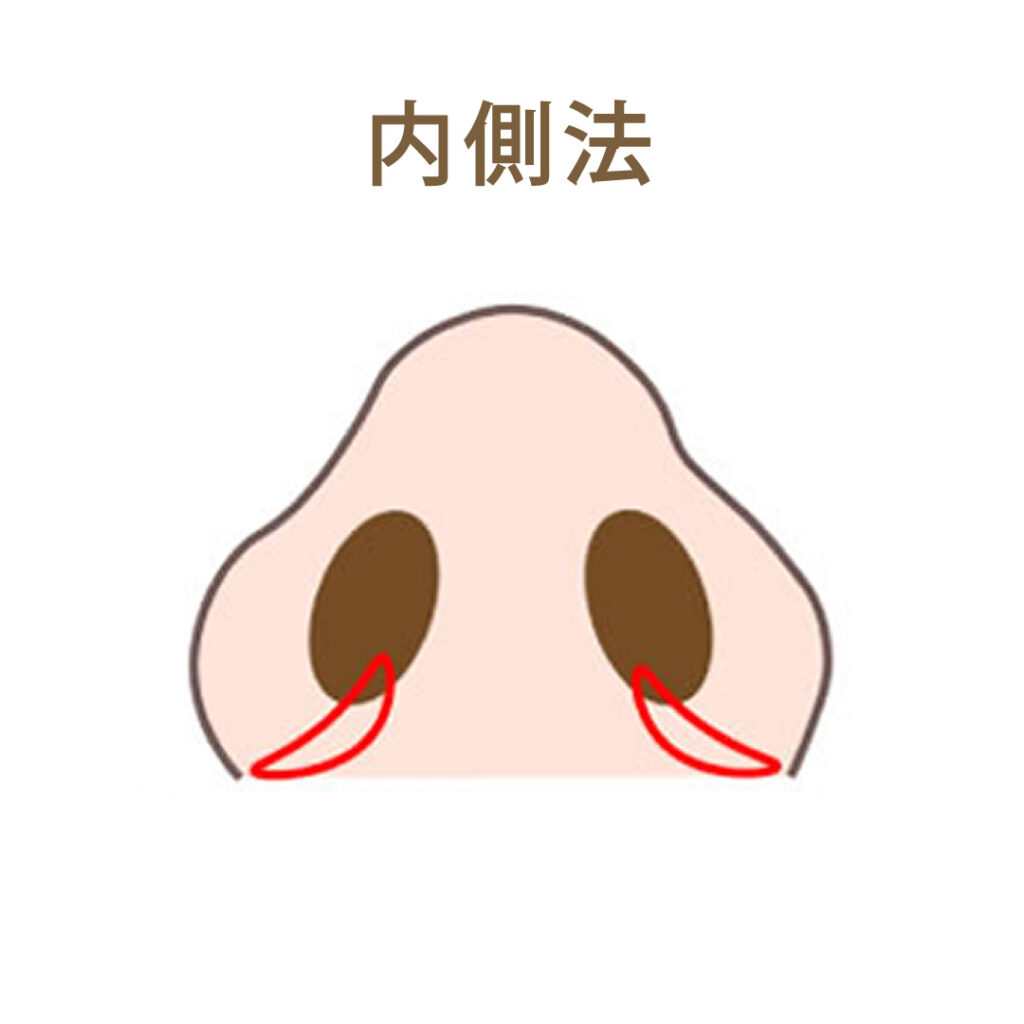 小鼻縮小内側法の図解