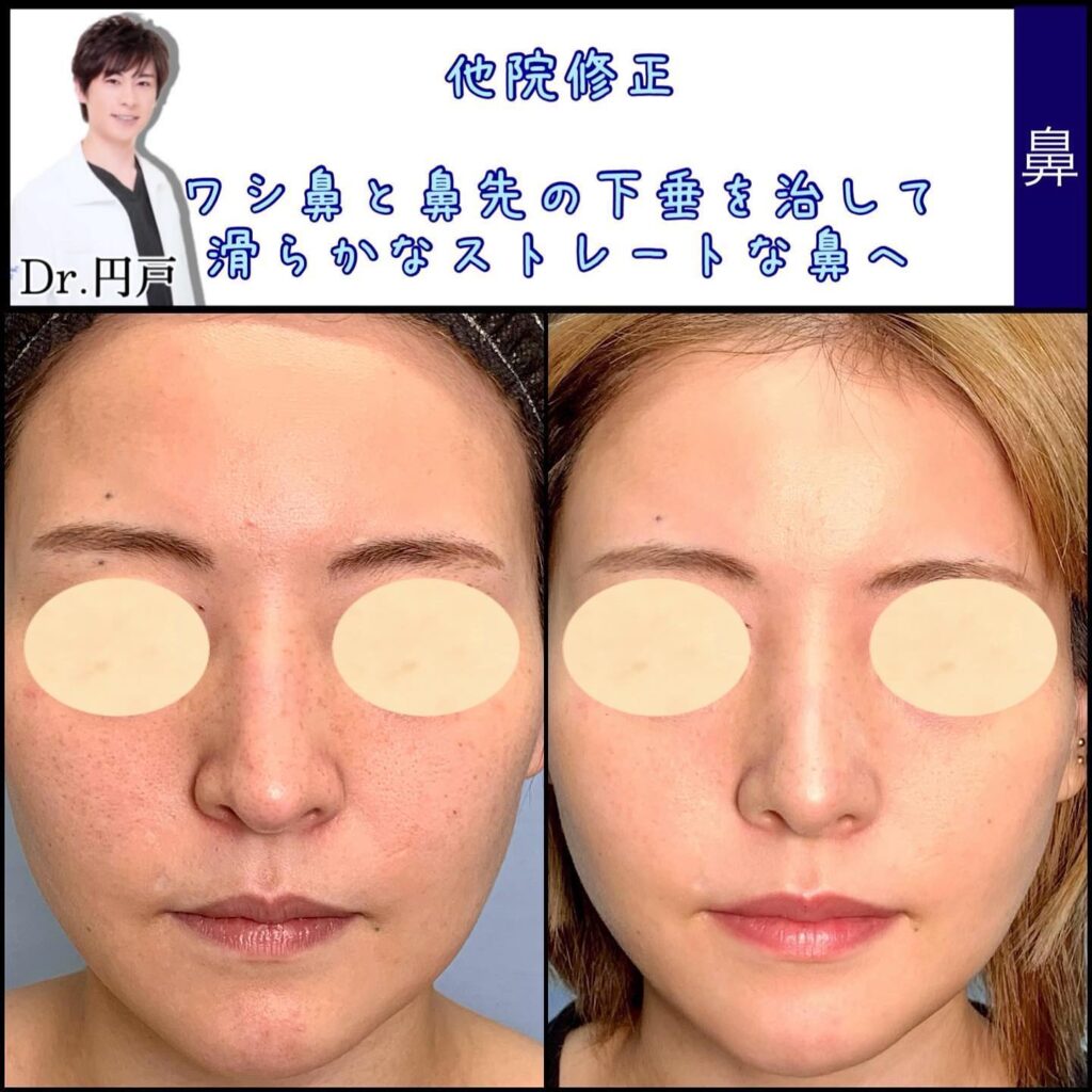 鼻の他院修正の症例写真 (7)