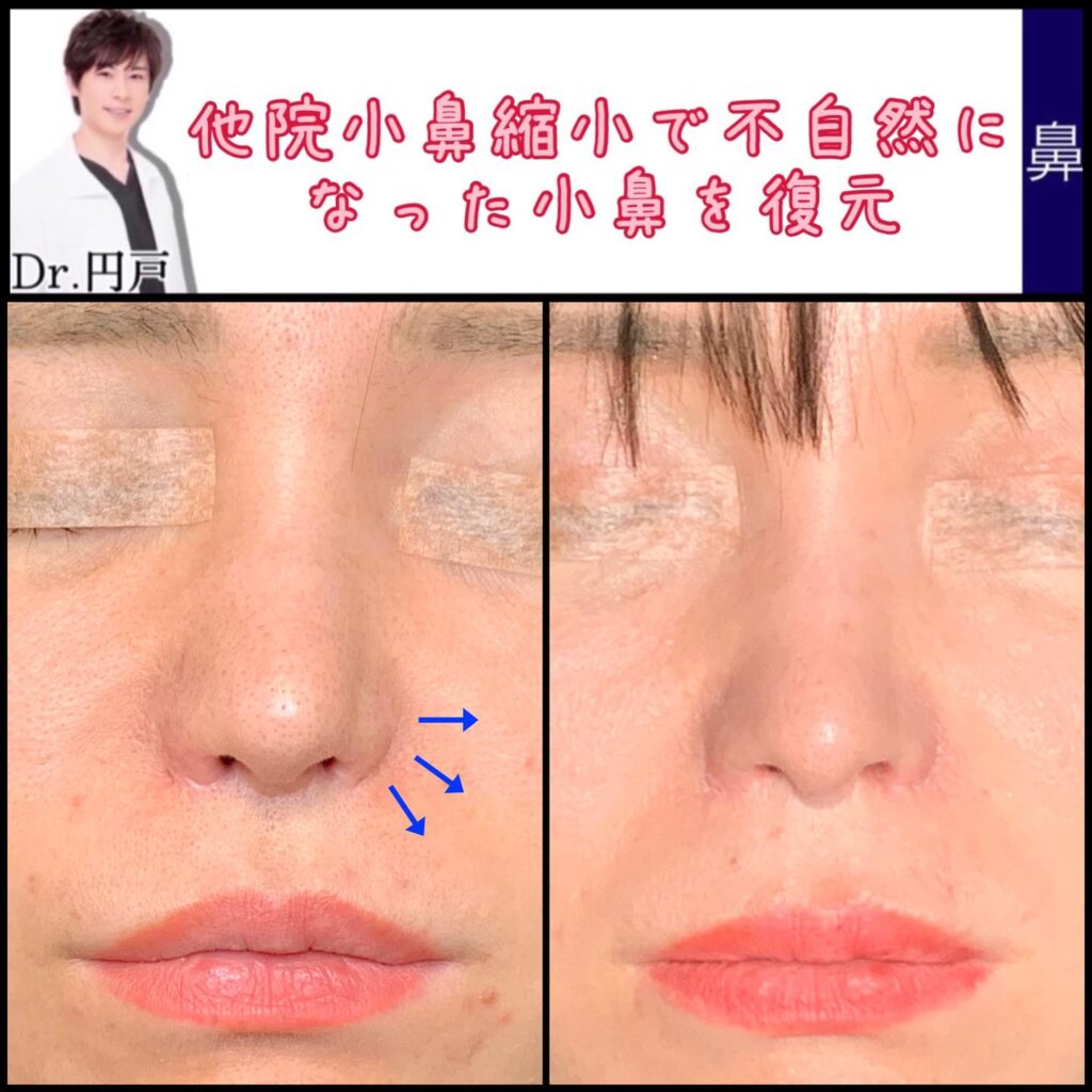 小鼻縮小手術での失敗を修正した症例