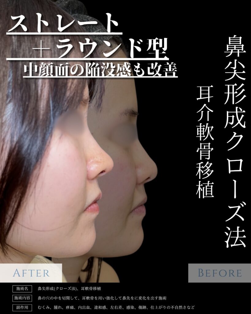 鼻尖形成と耳介軟骨移植の症例写真 (13)