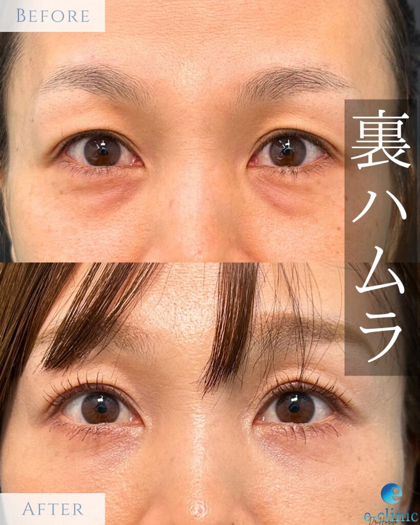 裏ハムラ法の症例写真 (17)