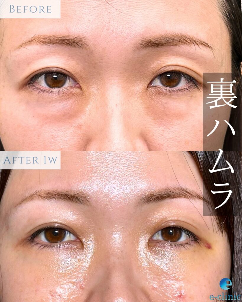 裏ハムラ法の症例写真 (18)