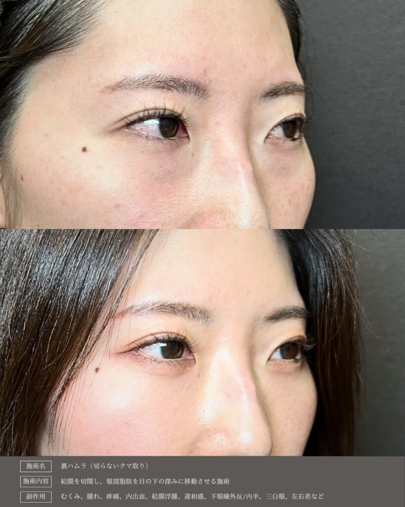 裏ハムラ法の症例写真 (25)