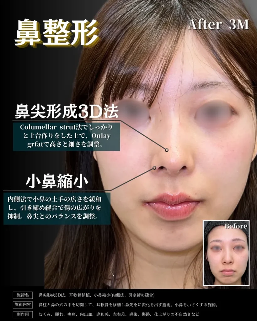 鼻整形_鼻尖形成3D法＋耳介軟骨移植＋小鼻縮小（内側法）（引き締め縫合）の症例（名医の相原隆充医師が執刀）