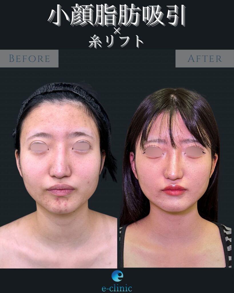 小顔脂肪吸引と糸リフトの症例写真 (3)