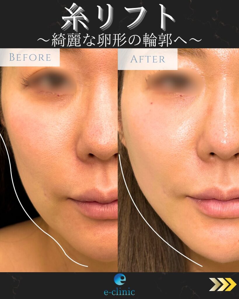 糸リフトの症例写真 (3)