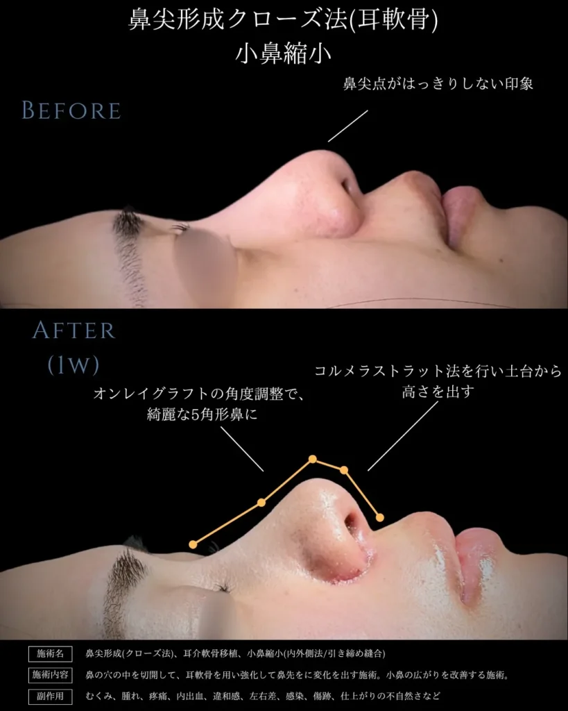 鼻整形_鼻尖形成クローズ法（耳軟骨）＋小鼻縮小の症例（名医の相原隆充医師が執刀）