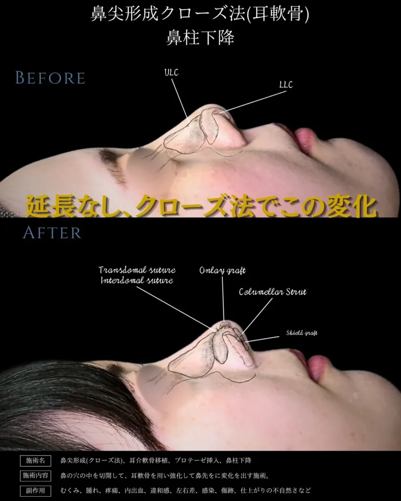 鼻整形_鼻尖形成クローズ法（耳軟骨）＋鼻柱下降の症例（名医の相原隆充医師が執刀）
