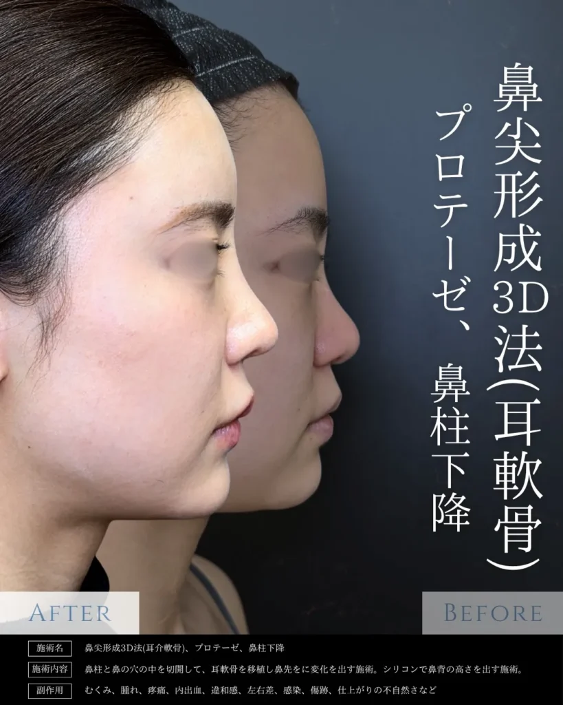 鼻整形_鼻尖形成3D法＋耳介軟骨移植＋鼻柱下降の症例＋プロテーゼ（名医の相原隆充医師が執刀）