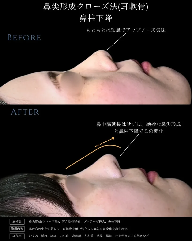 鼻整形_鼻尖形成クローズ法（耳軟骨）＋鼻柱下降の症例（名医の相原隆充医師が執刀）