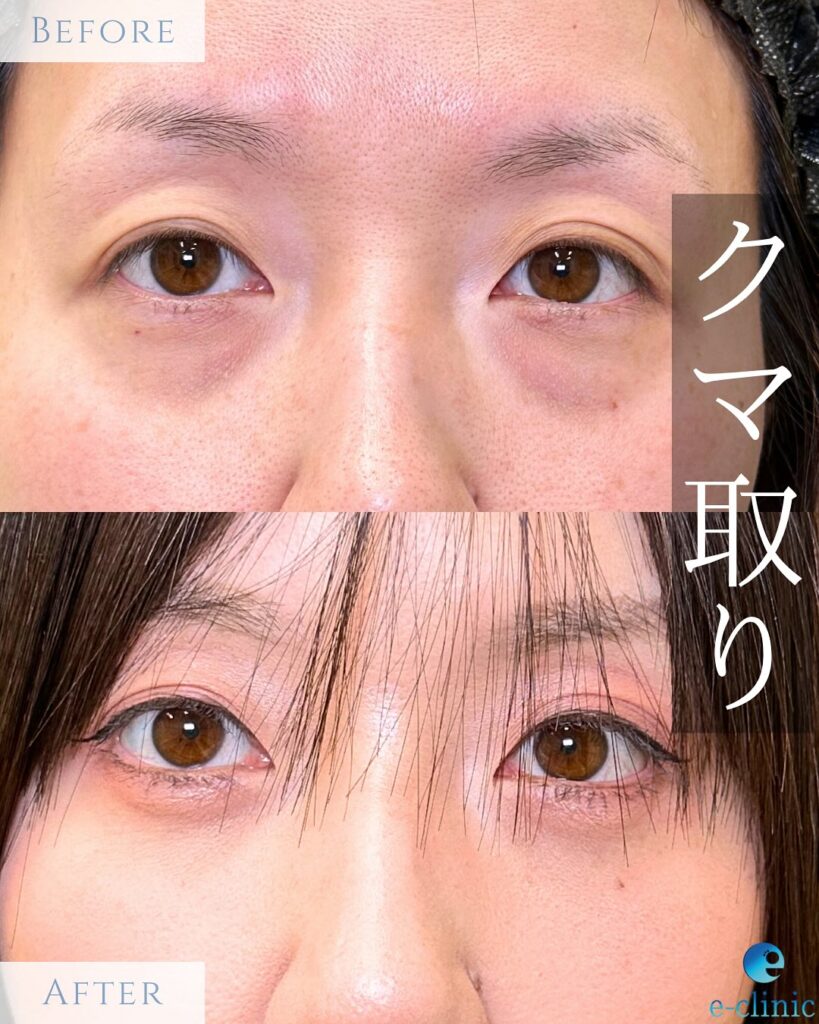 経結膜脱脂法の症例写真 (3)