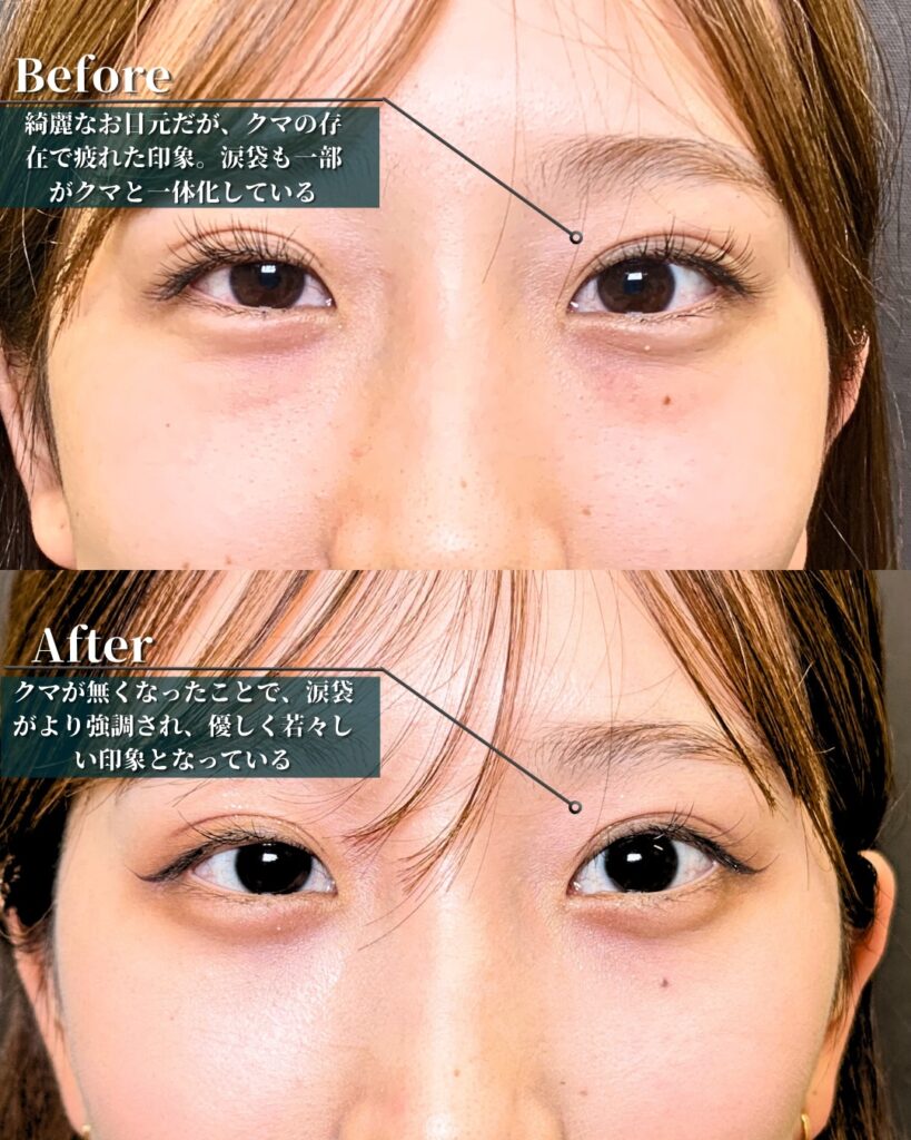裏ハムラ法の症例写真 (23)