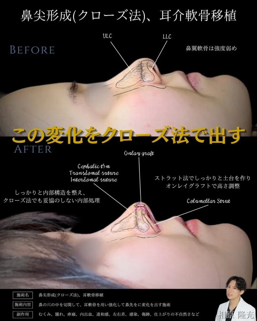 鼻整形_鼻尖形成クローズ法＋耳介軟骨移植の症例（名医の相原隆充医師が執刀）