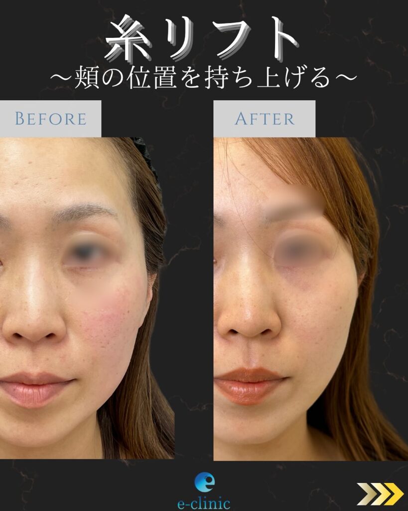 糸リフトの症例写真 (2)