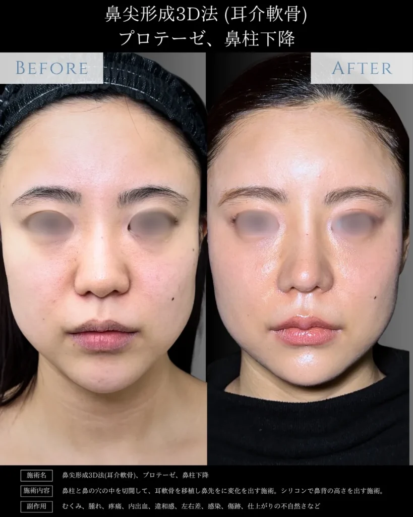 鼻整形_鼻尖形成3D法＋耳介軟骨移植＋鼻柱下降の症例＋プロテーゼ（名医の相原隆充医師が執刀）