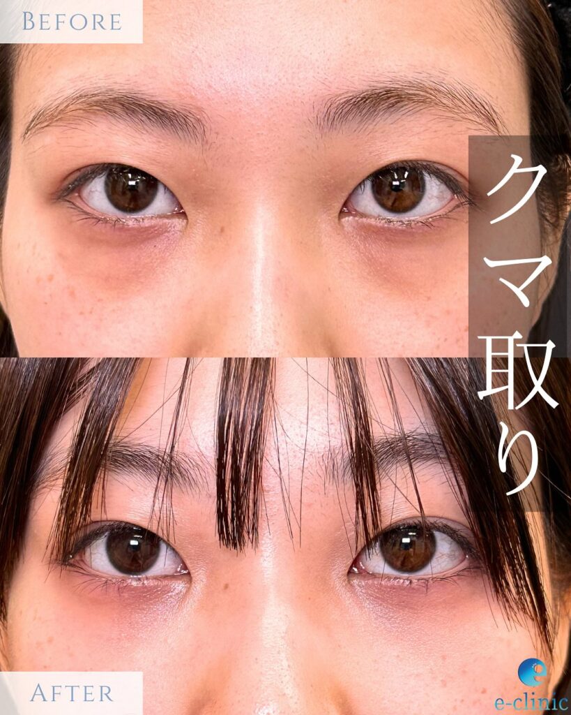 経結膜脱脂法の症例写真