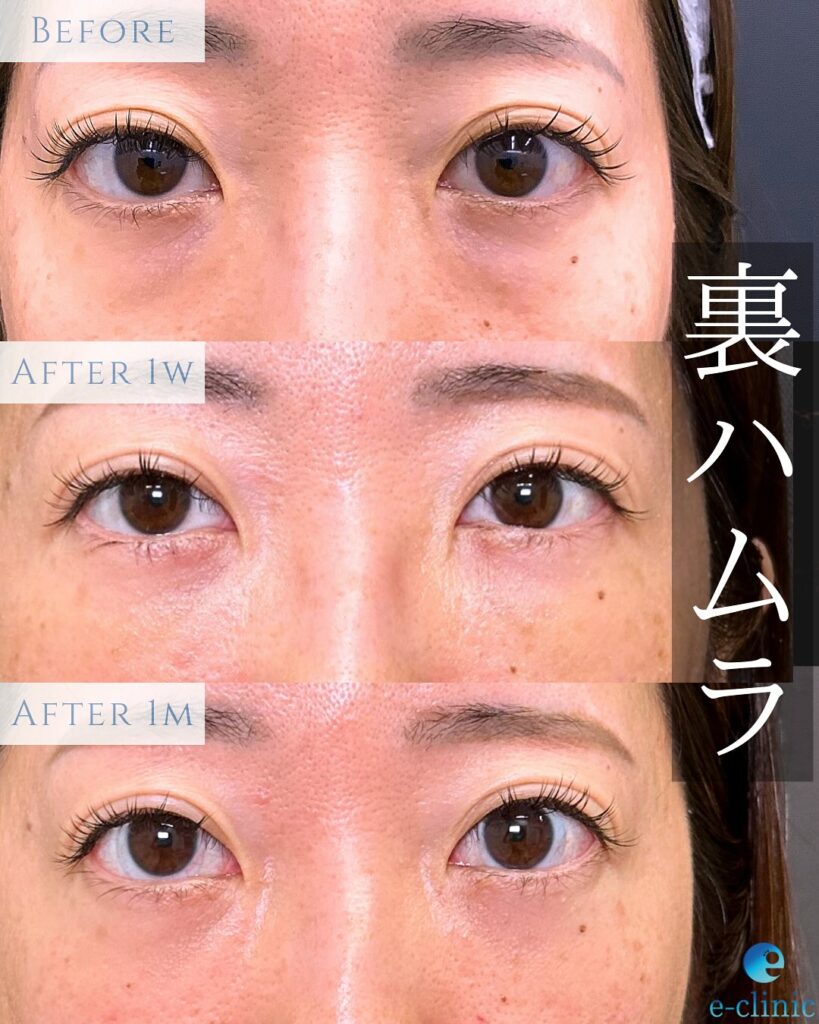 裏ハムラ法の症例写真 (19)
