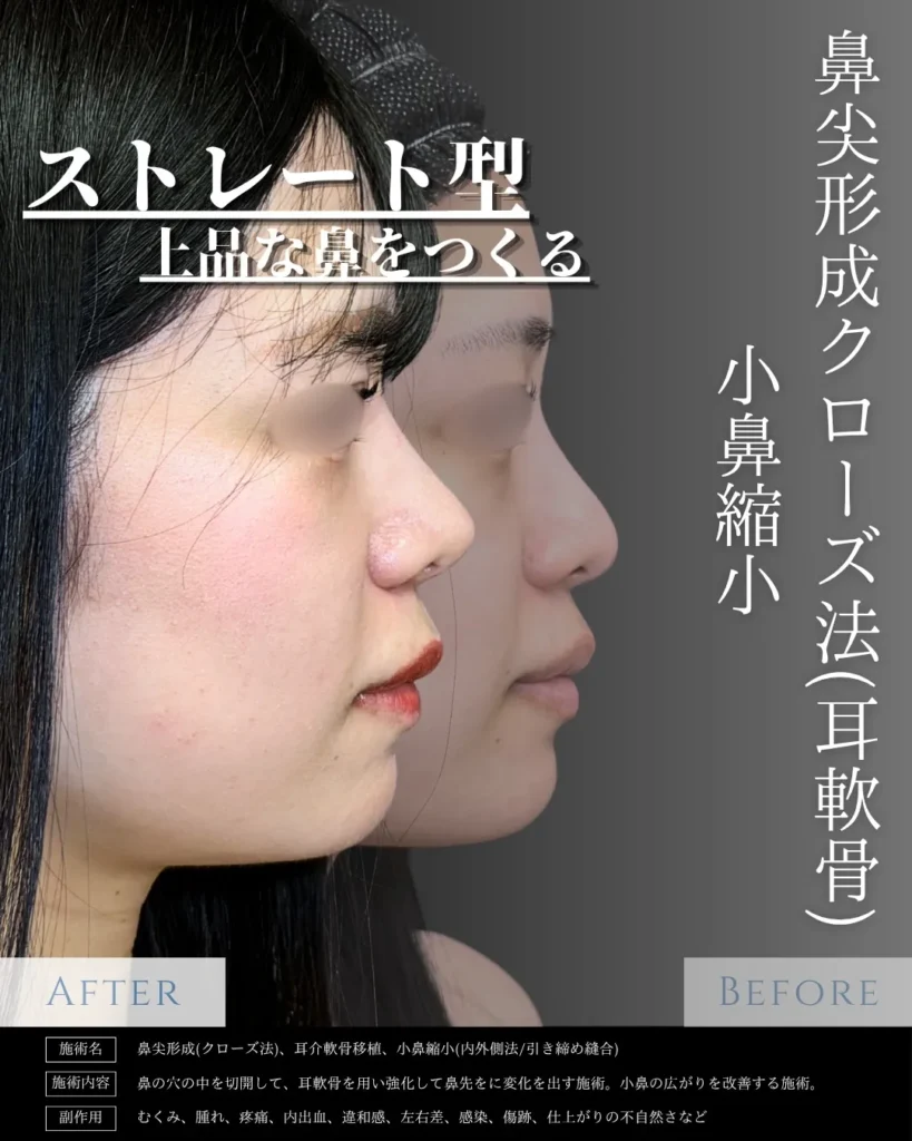 鼻整形_鼻尖形成クローズ法（耳軟骨）＋小鼻縮小の症例（名医の相原隆充医師が執刀）