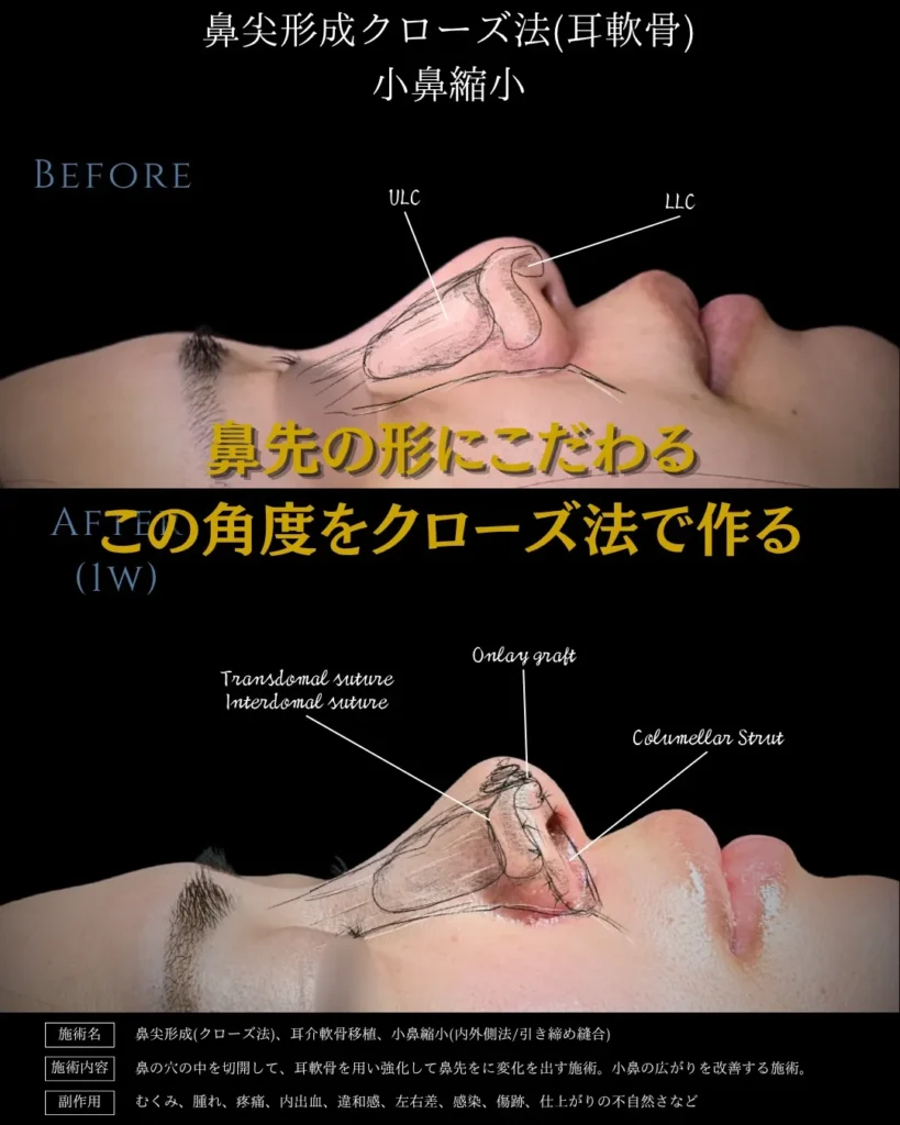 鼻整形_鼻尖形成クローズ法＋耳介軟骨移植＋小鼻縮小の症例（名医の相原隆充医師が執刀）