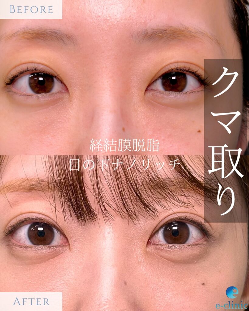 脱脂と脂肪注入の症例写真 (4)