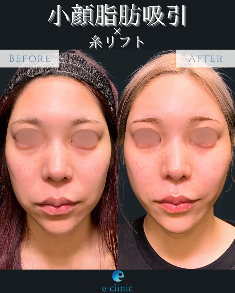小顔脂肪吸引と糸リフトの症例写真 (1)