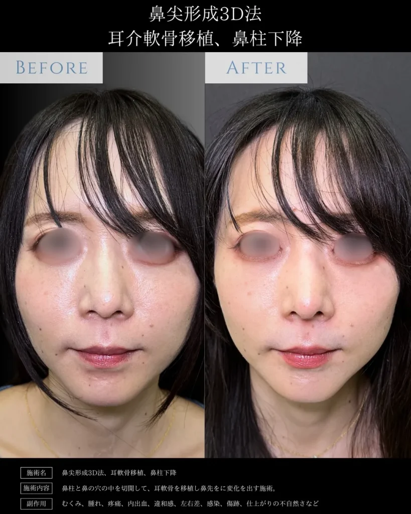 鼻整形_鼻尖形成3D法＋耳介軟骨移植＋鼻柱下降の症例（名医の相原隆充医師が執刀）