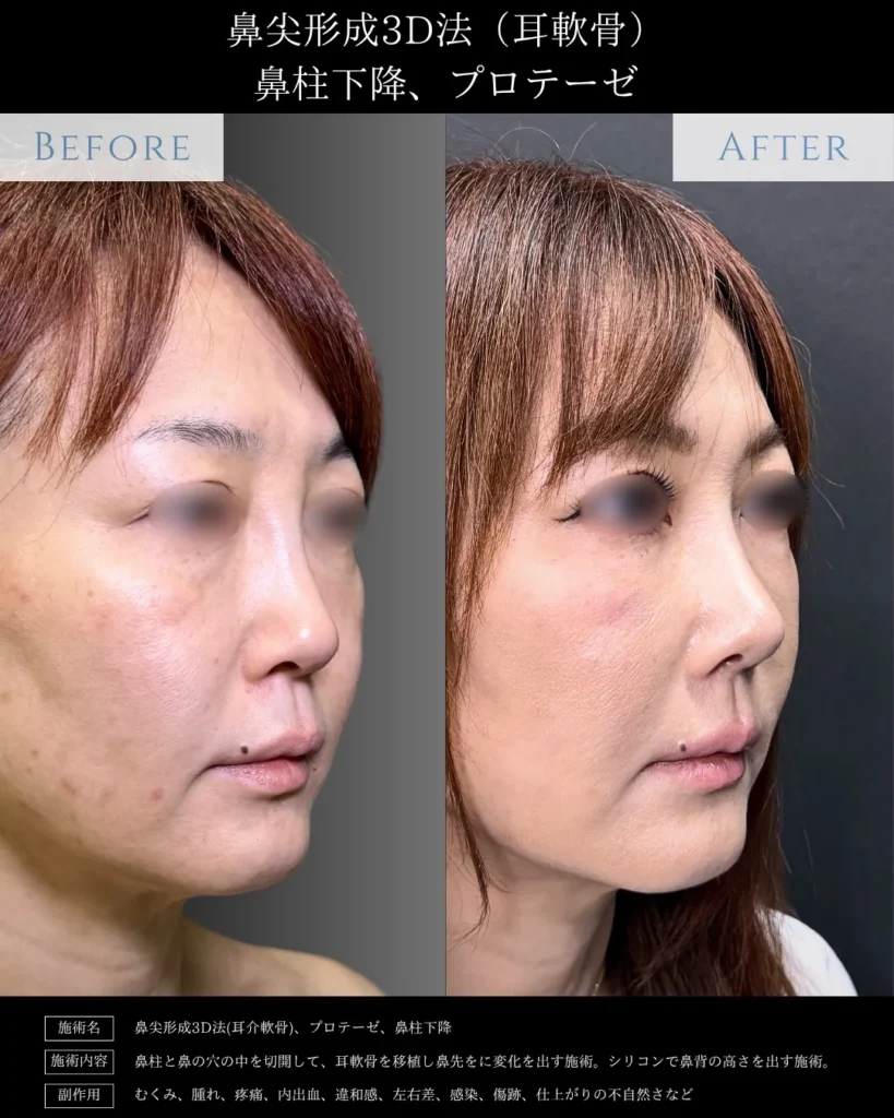 鼻整形_鼻尖形成クローズ法＋耳介軟骨移植＋鼻柱下降の症例（他院修正）（名医の相原隆充医師が執刀）