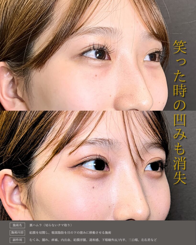 裏ハムラ法の症例写真 (16)