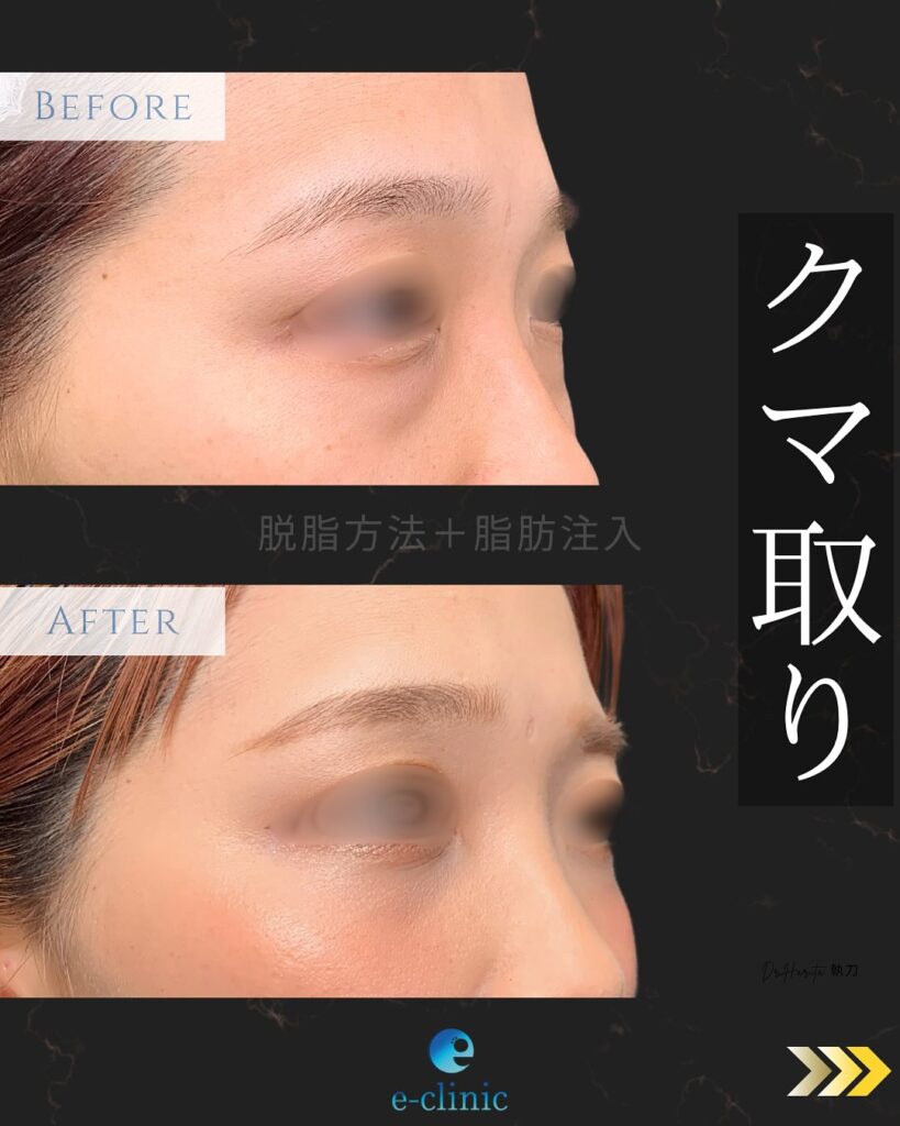 脱脂と脂肪注入の症例写真 (2)