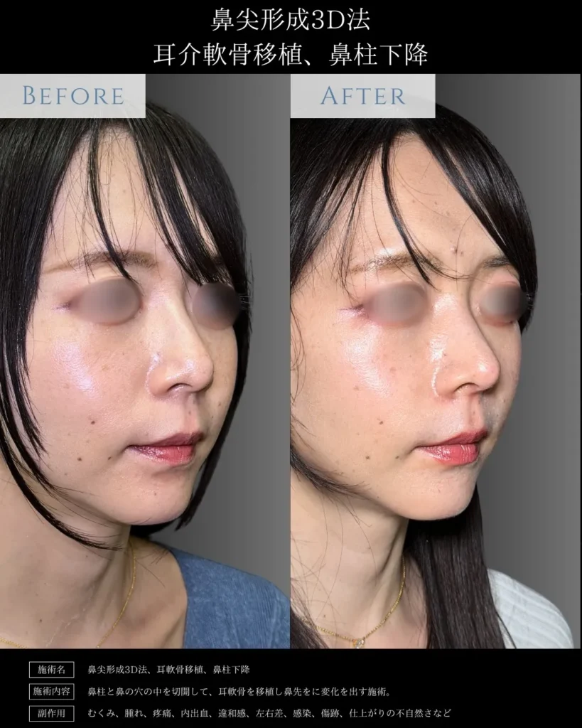 鼻整形_鼻尖形成3D法＋耳介軟骨移植＋鼻柱下降の症例（名医の相原隆充医師が執刀）