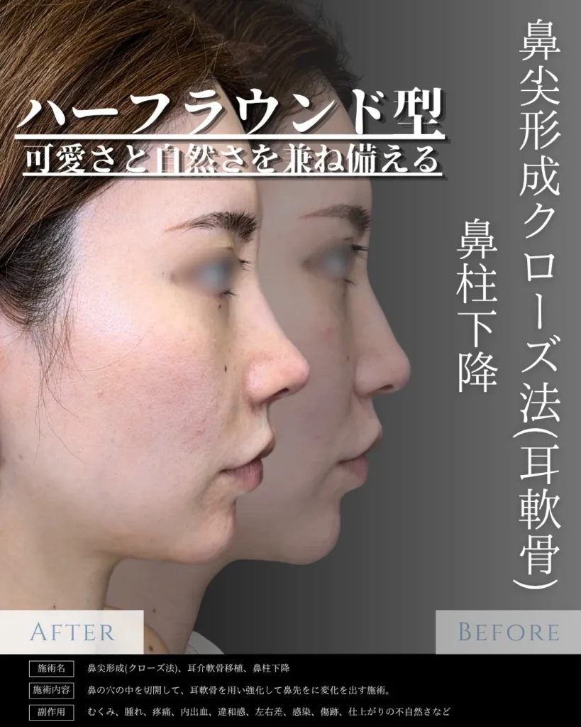 鼻整形_鼻尖形成クローズ法＋耳介軟骨移植＋鼻柱下降の症例（名医の相原隆充医師が執刀）
