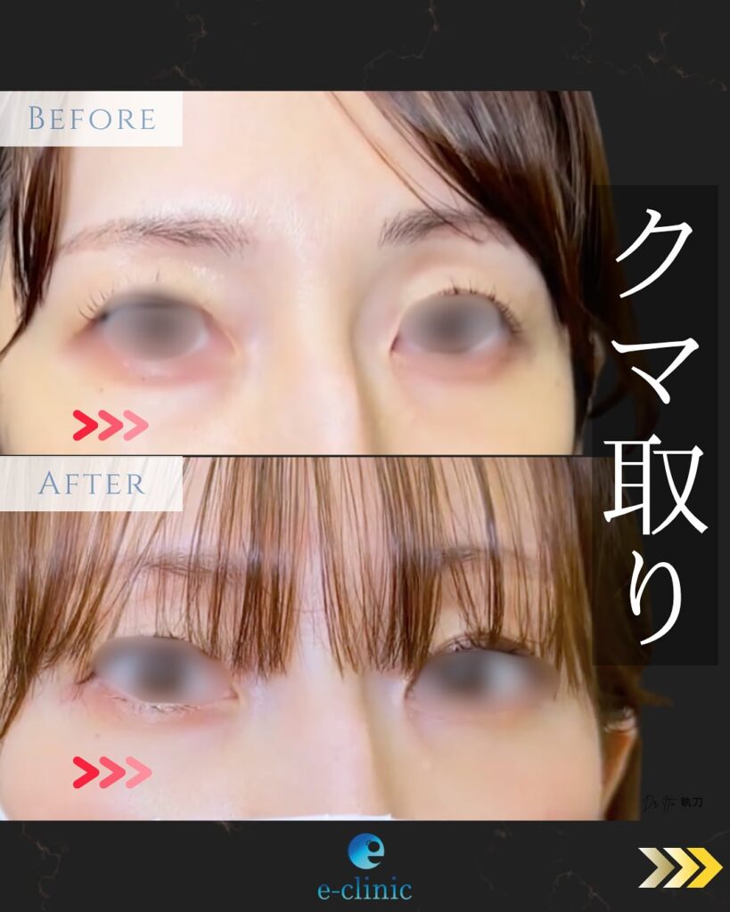 経結膜脱脂法の症例写真 (2)