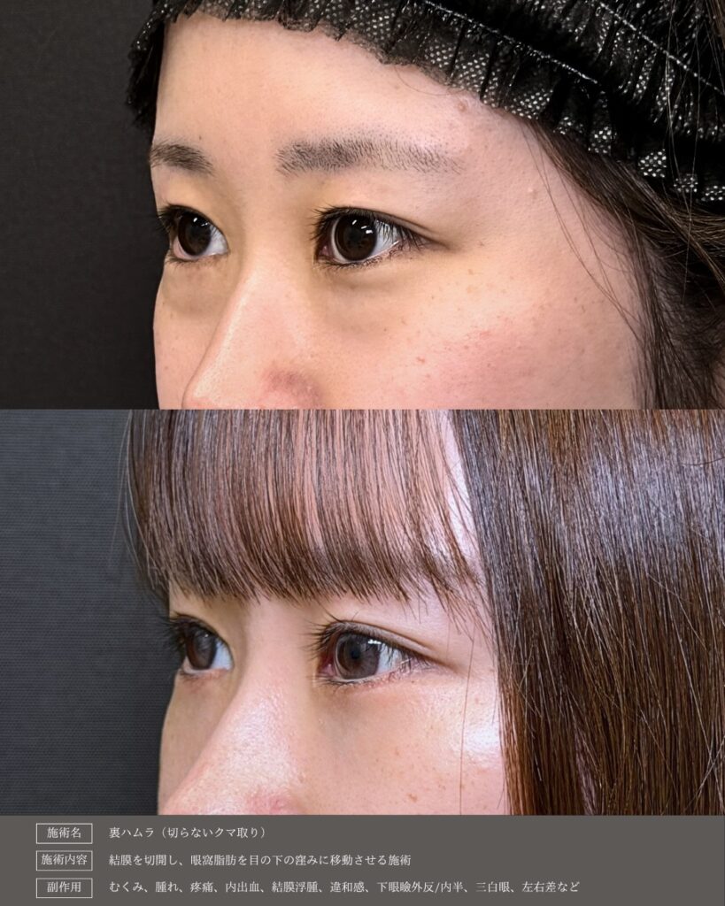 裏ハムラ法の症例写真 (34)