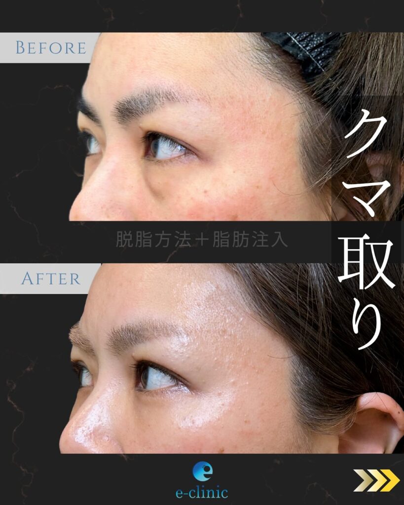 経結膜脱脂法と脂肪注入の症例写真