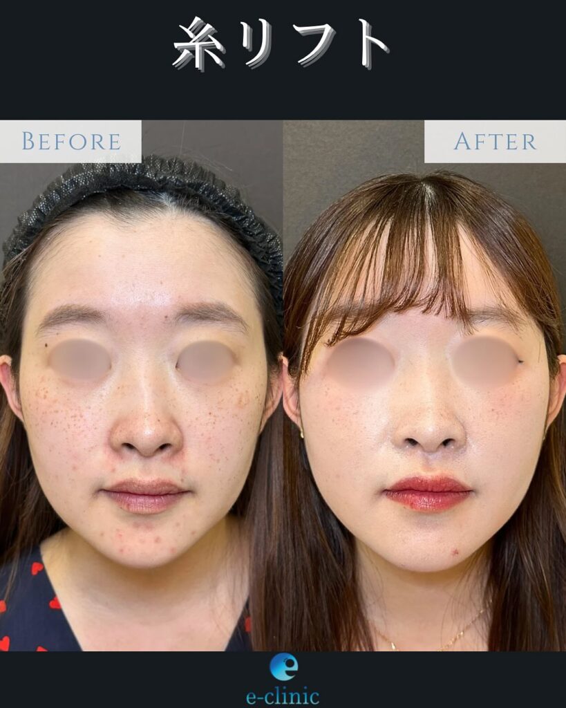 糸リフトの症例写真 (8)