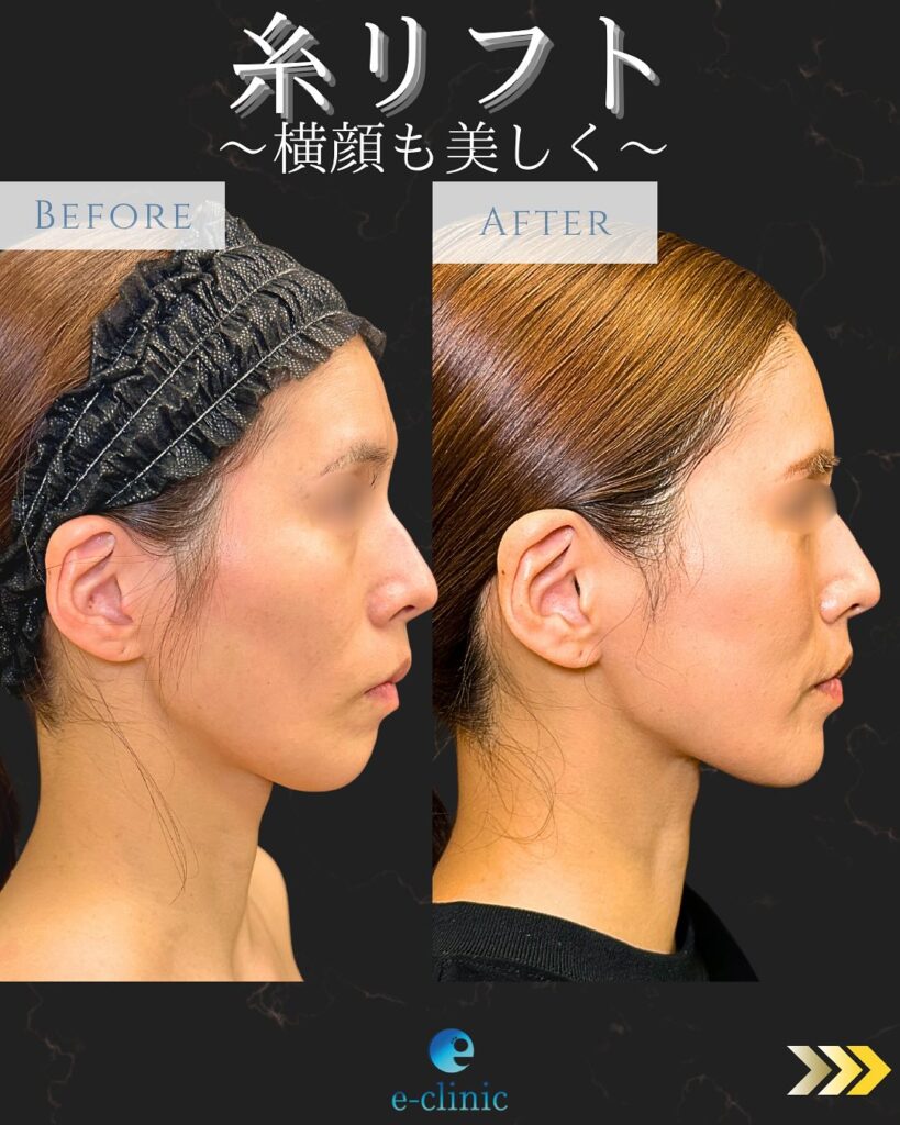糸リフトの症例写真 (20)