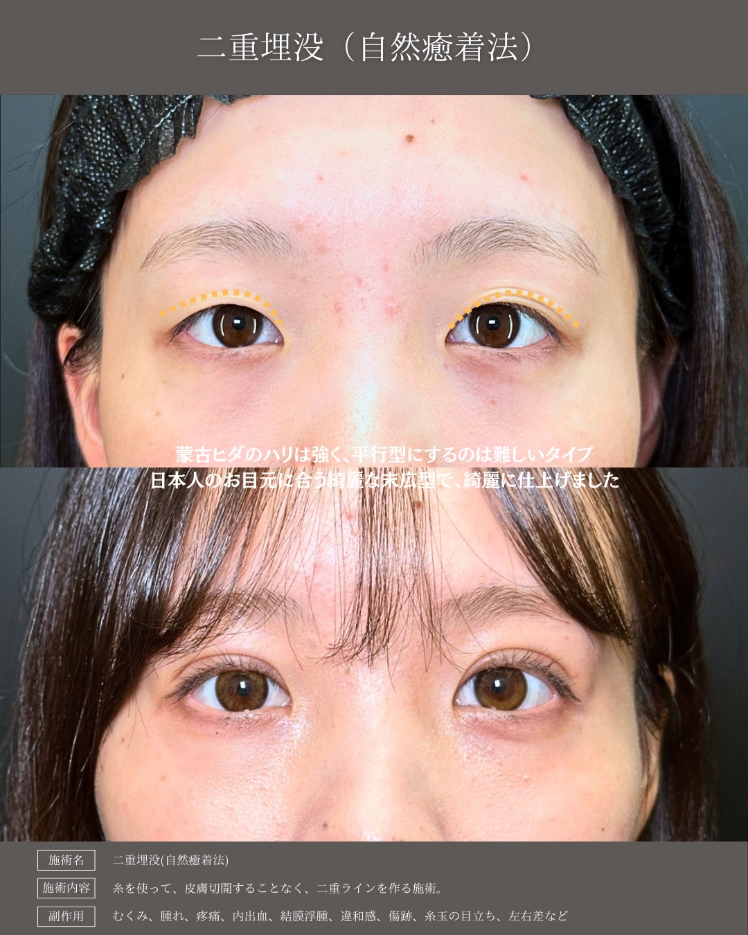 埋没法の症例写真 (6)