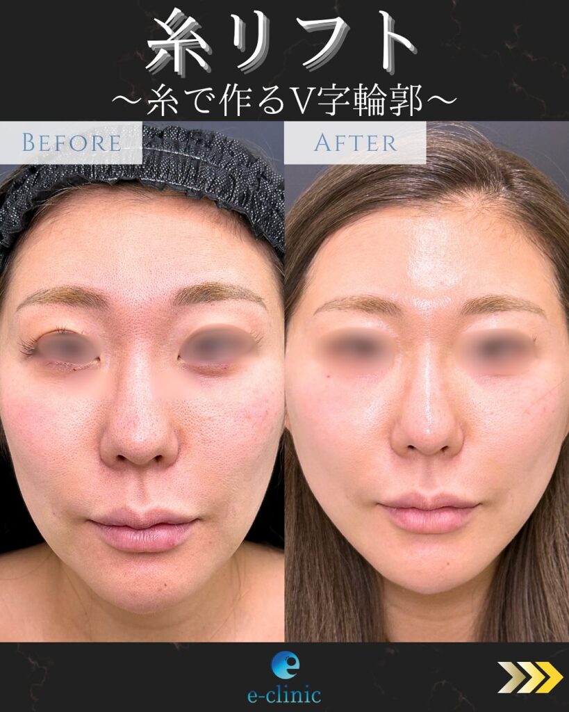 糸リフトの症例写真 (25)