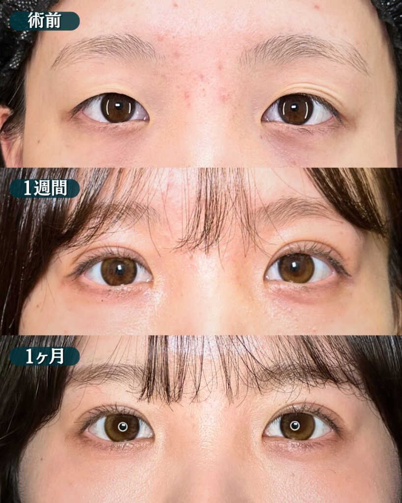埋没法の症例写真 (9)