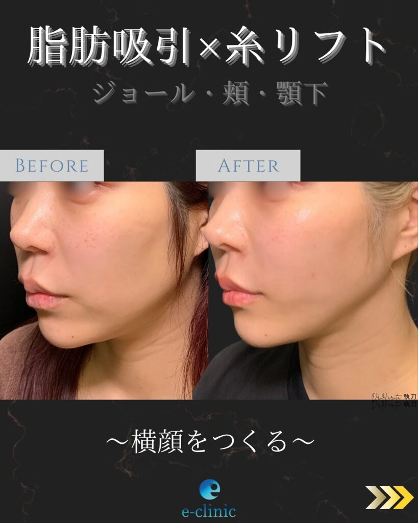 脂肪吸引と糸リフトの症例写真 (3)