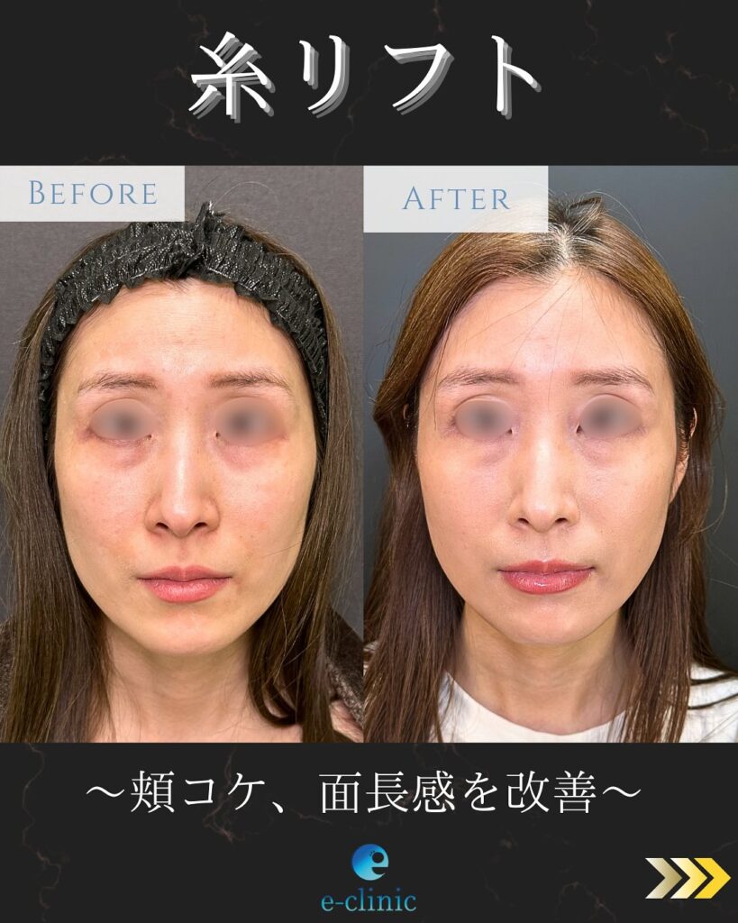 糸リフトの症例写真 (24)