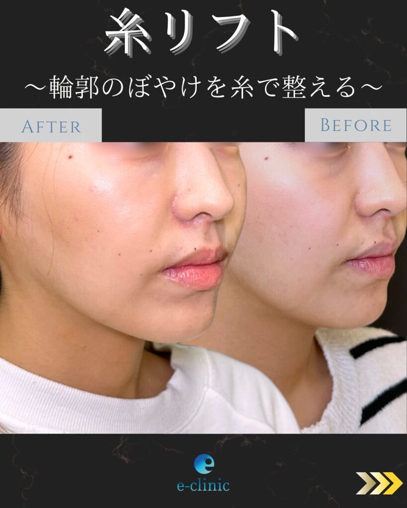 糸リフトの症例写真 (26)