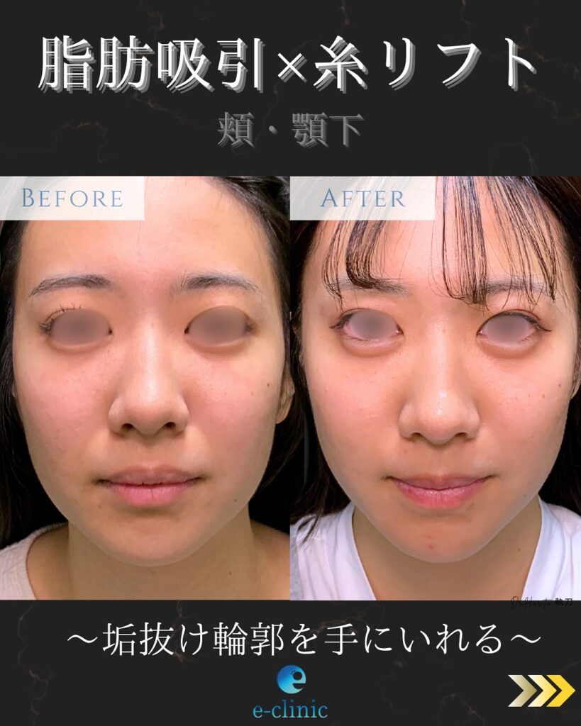 顔の脂肪吸引と糸リフトの症例写真 (2)