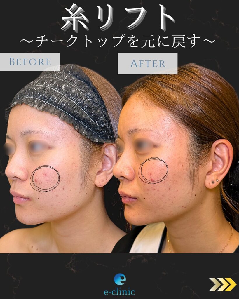 糸リフトの症例写真 (22)