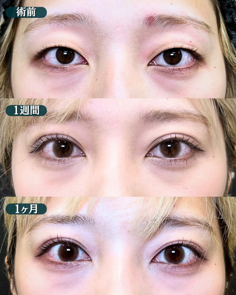 埋没法の症例写真 (1)